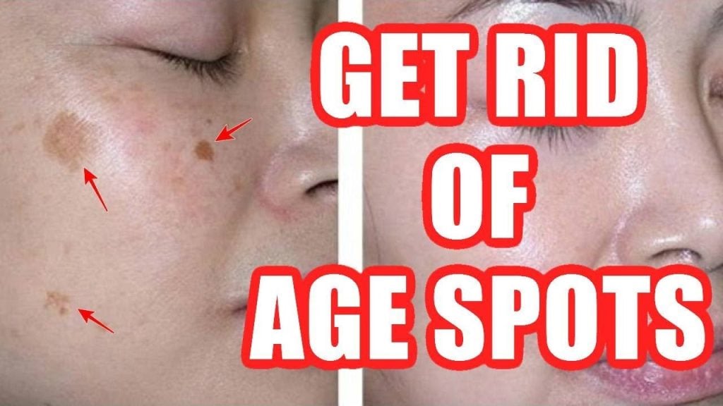 How to Get Rid of Age Spots Naturally
